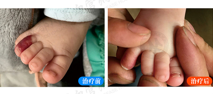 婴幼儿脚趾血管瘤.jpg